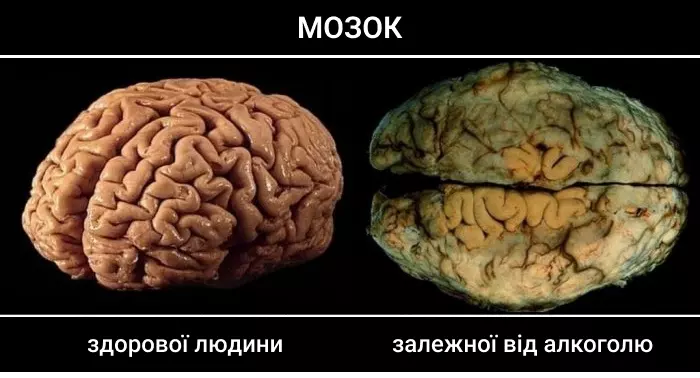 вплив алкоголю на мозок
