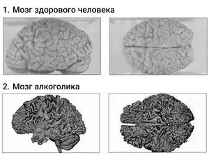 восстановление мозга после алкоголя