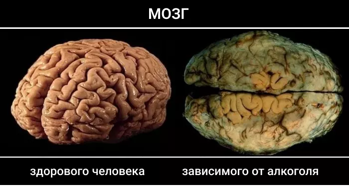 влияние алкоголя на мозг