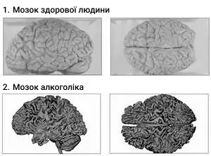 мозок алкоголіка
